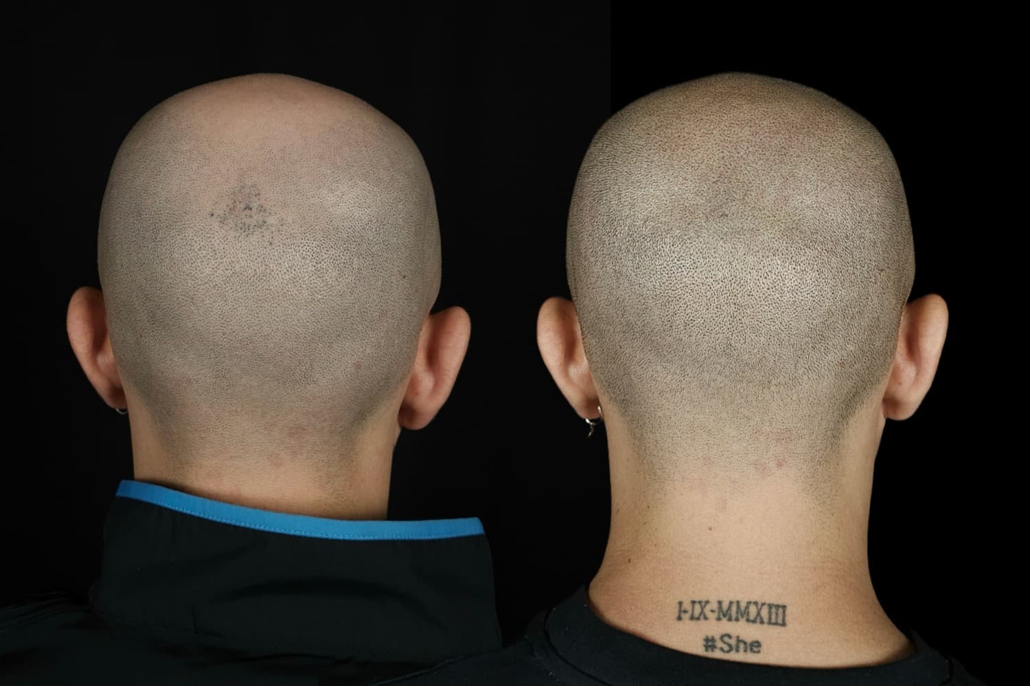 Micropigmentación Capilar: Solución Efectiva para la Pérdida de Cabello